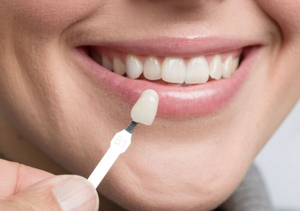 Tandkroner sættes på beskadigede tænder