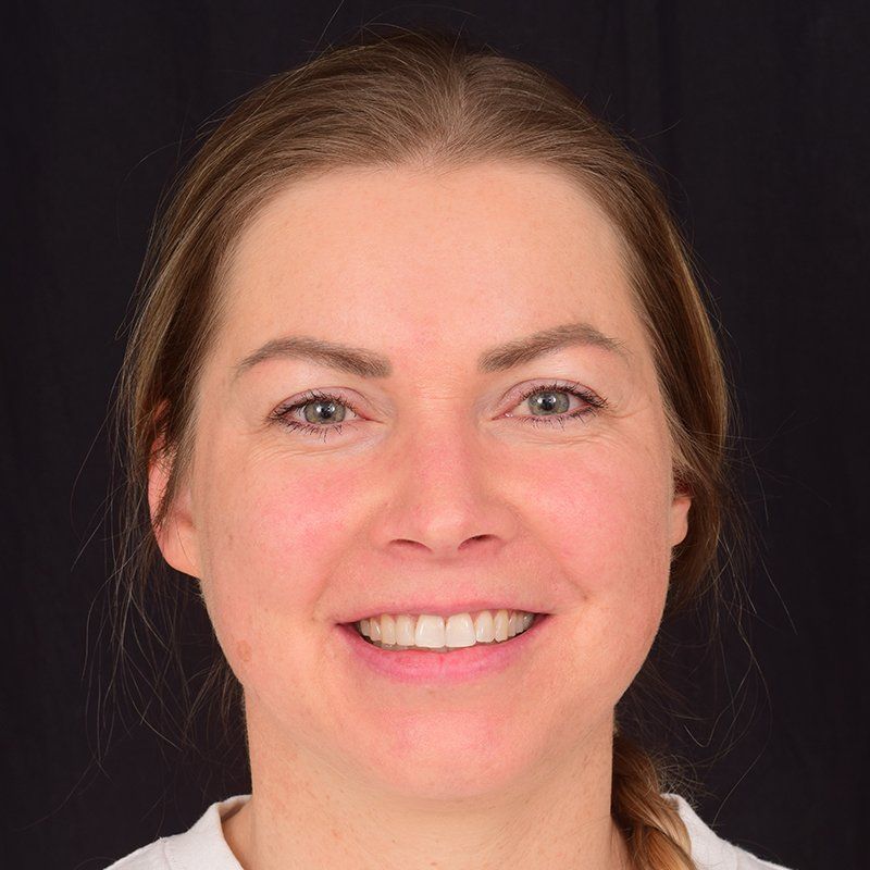 Foto af tænder efter Invisalign