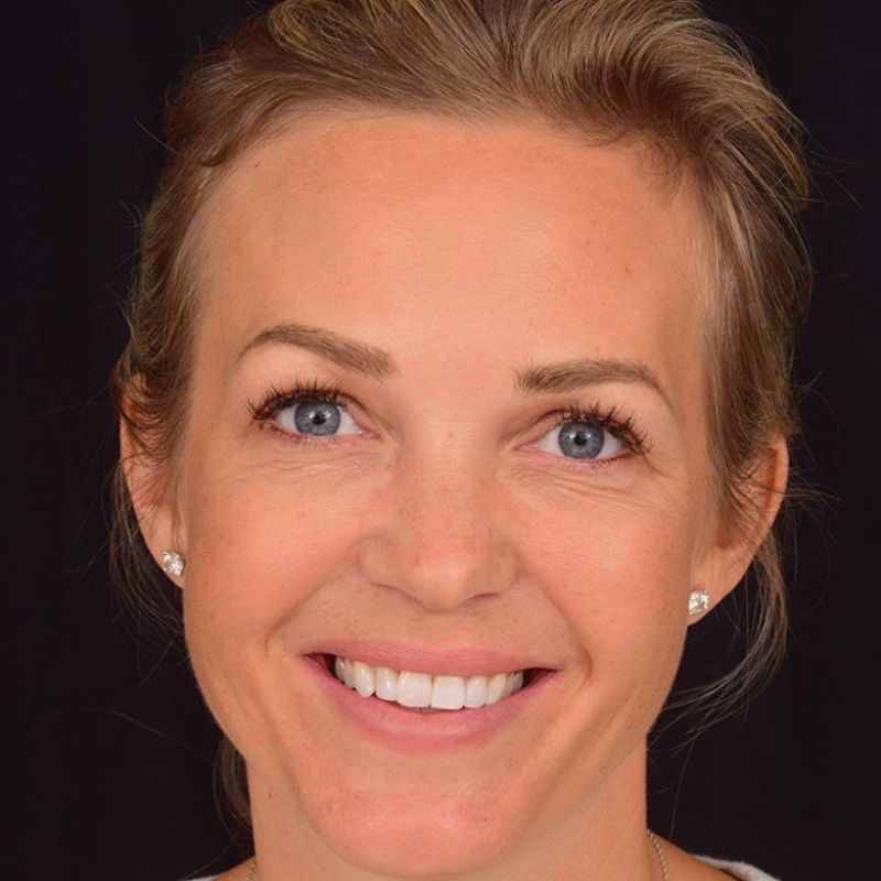 Tina Lund efter behandlingen med den diskrete tandbøjle 