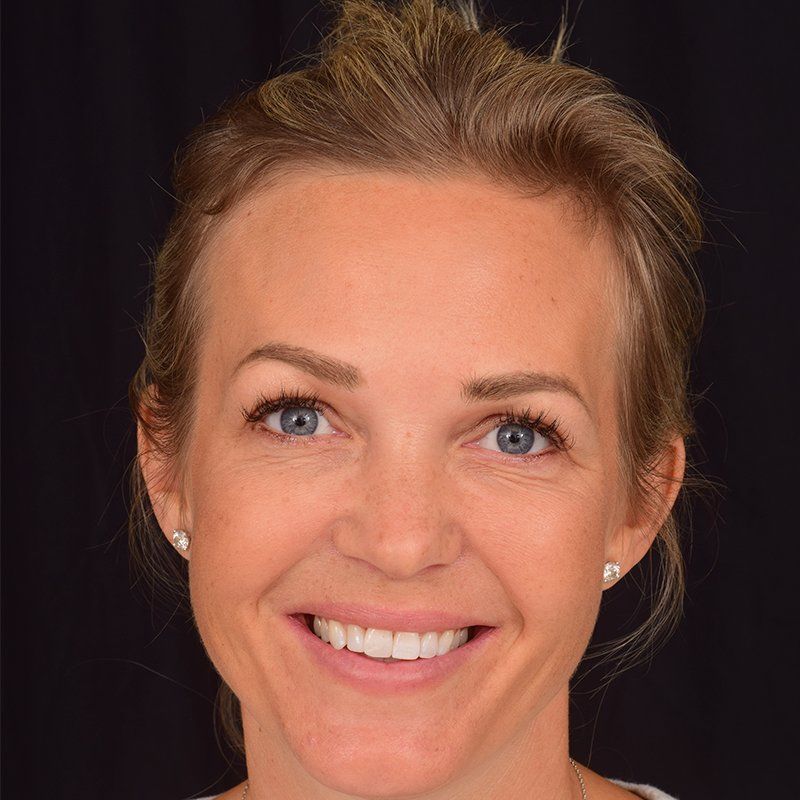 Tina Lund efter sin usynlige tandretning med Invisalign-bøjlen