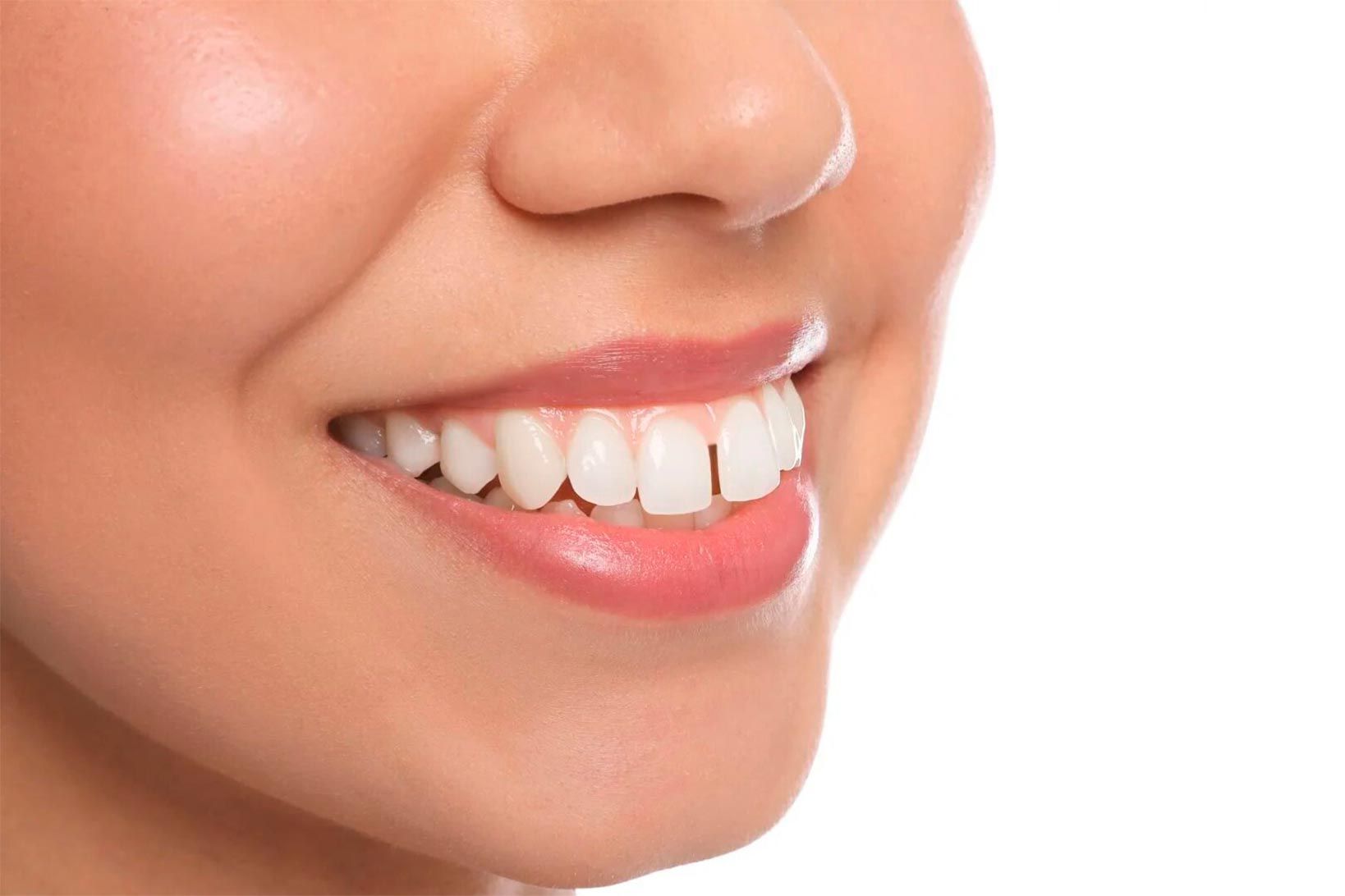 Mellemrum mellem tænderne kan behandles med Invisalign