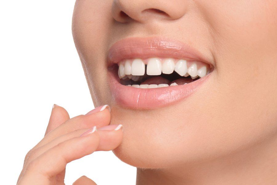 Mellemrum mellem tænderne – en typisk tandstillingsfejl